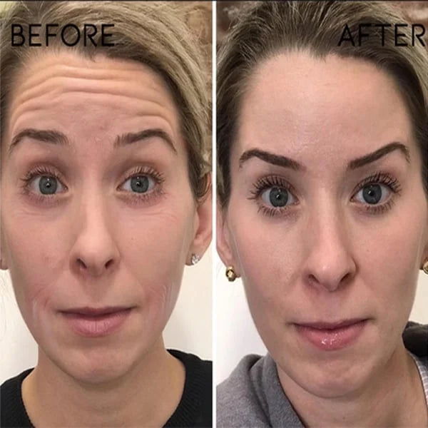 đBuy 1 Get 1 Freeđ - Botox Face Serum