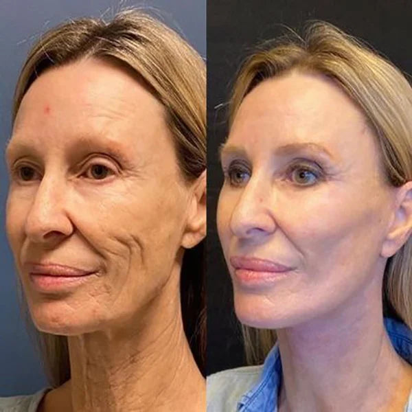 🎉Buy 1 Get 1 Free🎁 - Botox Face Serum