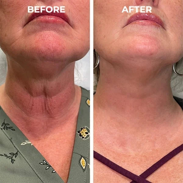🎉Buy 1 Get 1 Free🎁 - Botox Face Serum