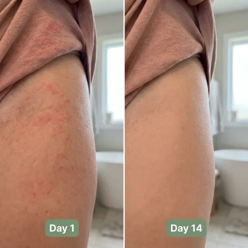 💚 LAST DAY BUY 1 GET 1 FREE✨Intertrigo Relief Cream treats 99% of skin fold rashes from the first application  Intertrigo Cream🛒