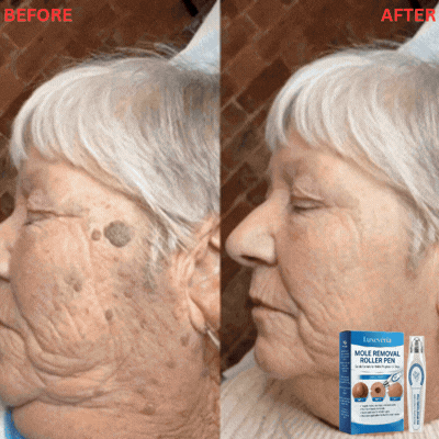 Your Skin Tags Aren't a Sign of Aging. They're Your Body's Alarm Bell.