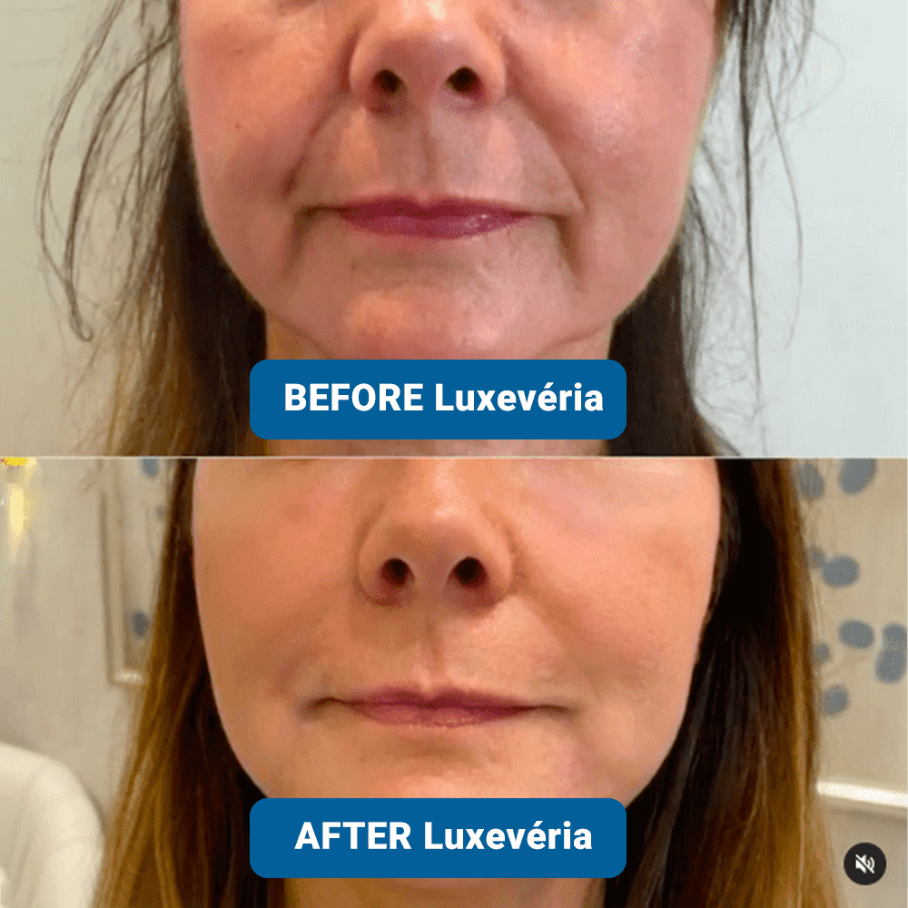 ✨ Last Day Buy 1 Get 1 Free ✨3% Hyaluronic Acid Ultra Hydrating Serum by Luxevéria