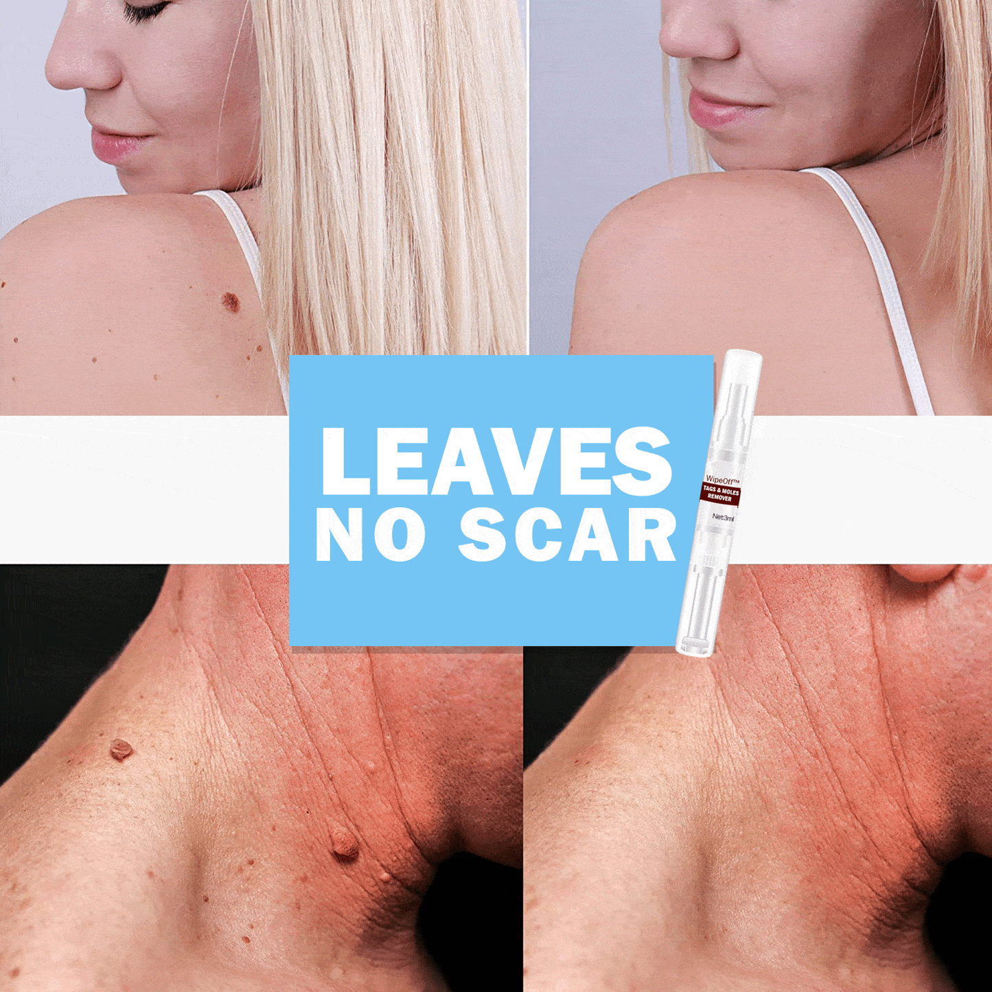 WipeOff  Tags   Moles Remover